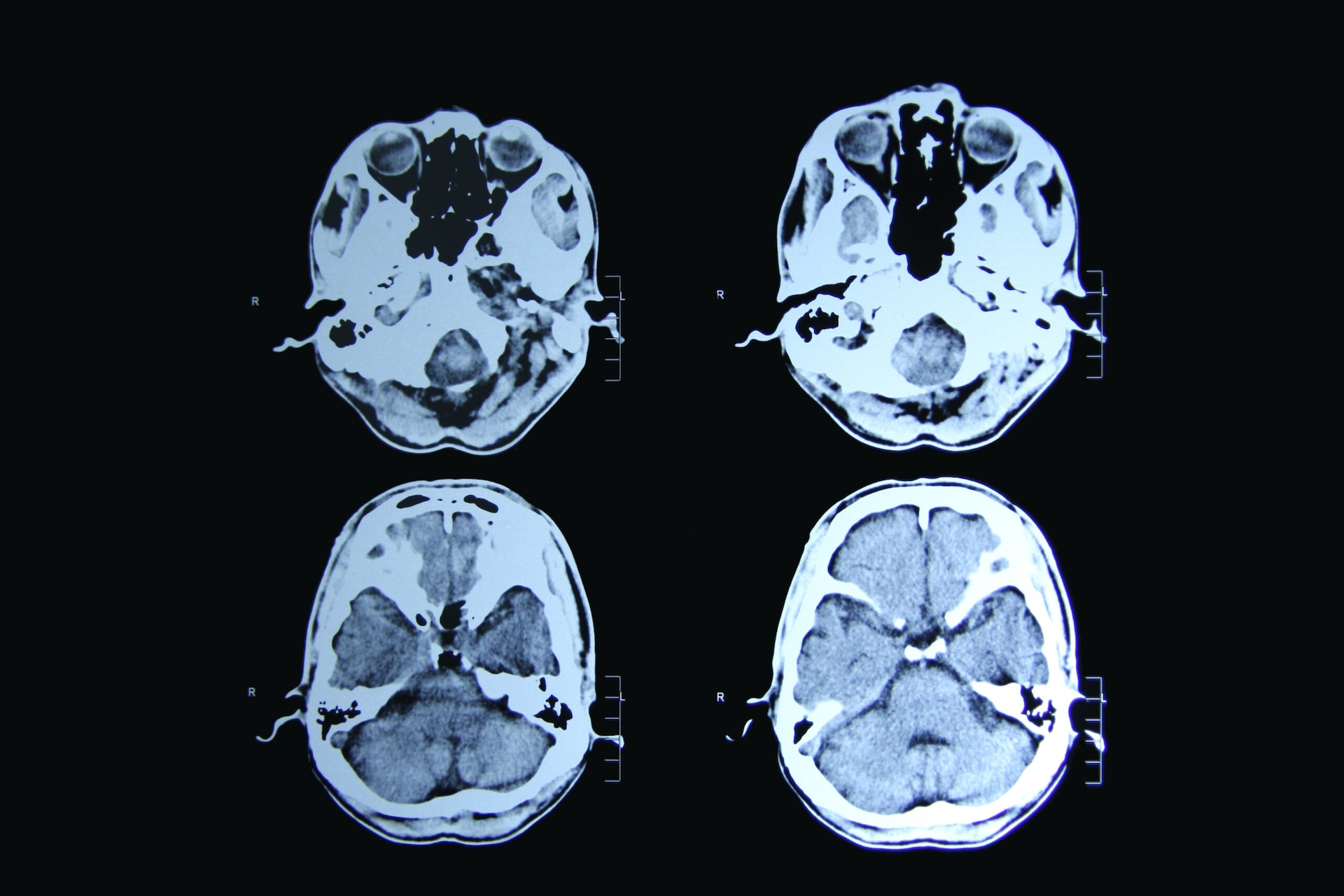 UBC researchers trace a disease mechanism inside vulnerable neurons.